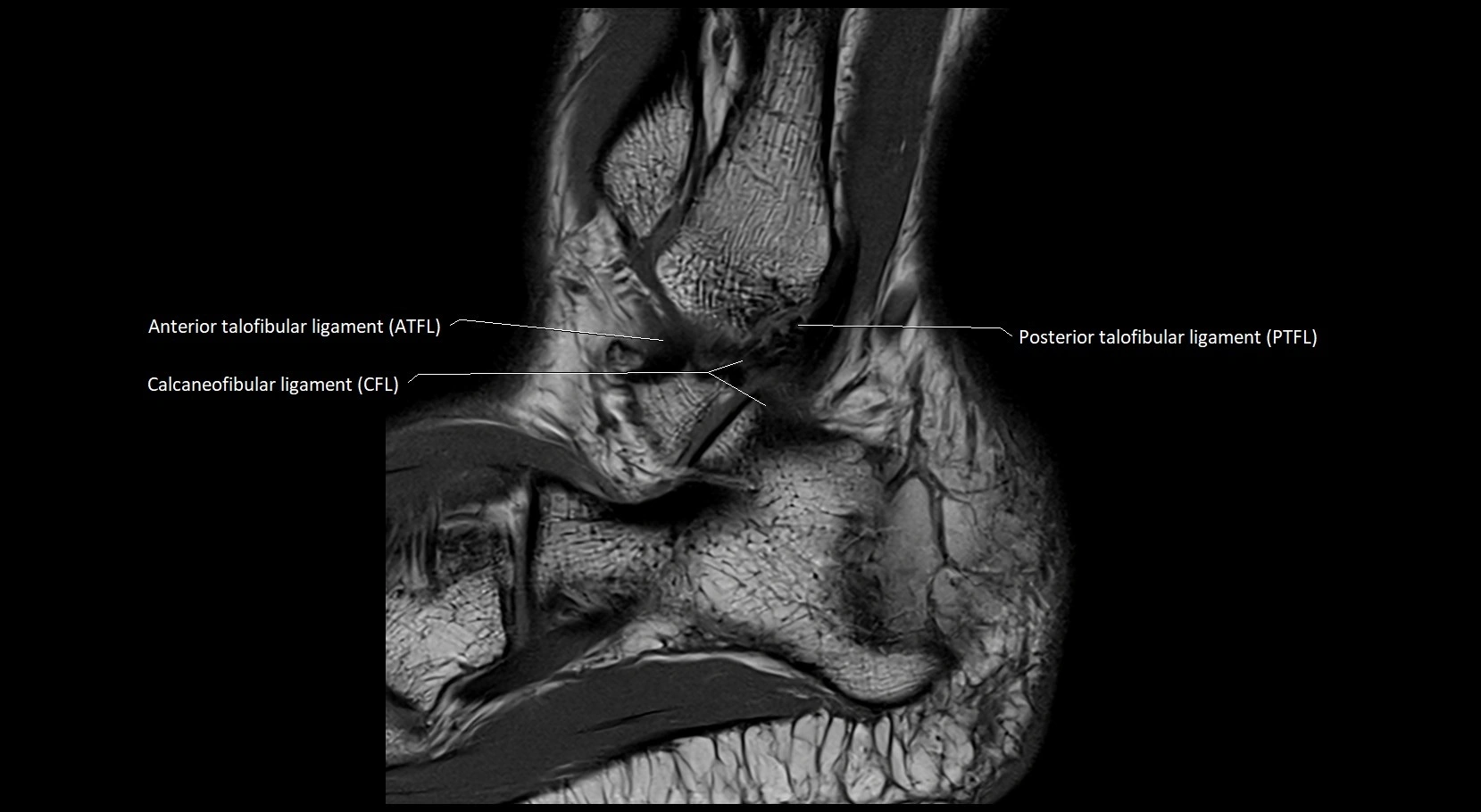 MRI ankle ligaments anatomy sagittal 3T image 23.webp